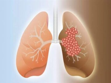 مهندسی معکوس پیچیدهترین داروی ریوی جهان توسط متخصصان ایرانی