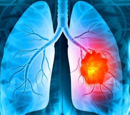 درمان تغییرات ایجادشده در میکروبیوم ریه بر اثر سیگار کشیدن