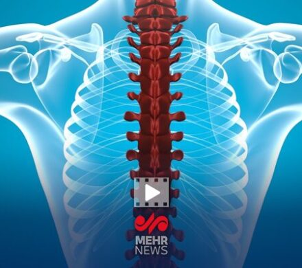 فلج اندامها از عوارض شکستن قلنج توسط ماساژورها